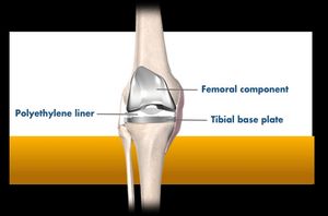 picture of my knee, prior to replacement surgery